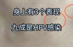 无症状感染自己有感觉吗，感染hpv有什么症状