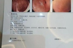 治疗胃食管反流权威医院，胃食管反流最好的医院