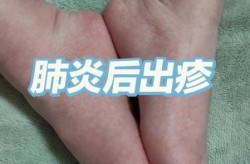 儿童病毒感染会有什么症状，儿童病毒感染的症状有哪些