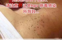 病毒感染有什么症状表现，病毒感染最明显的症状