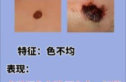 黑色素瘤和黑痣的判断，普通痣和黑色素痣区别