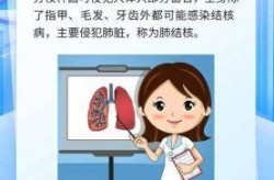 结核病聚集性疫情定义，肺结核聚集性疫情标准