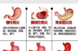 胃病转向胃癌5个信号，胃癌发出的第一个信号