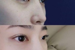 自体软骨隆鼻前后对比，自体软骨隆鼻有什么害处