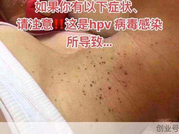 病毒感染有什么症状表现，病毒感染最明显的症状