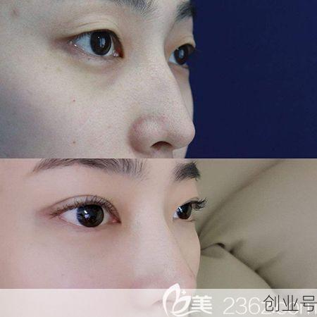 自体软骨隆鼻前后对比,自体软骨隆鼻有什么害处