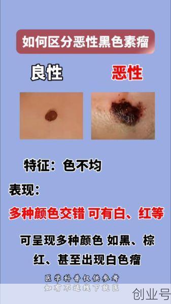 黑色素瘤和黑痣的判断,普通痣和黑色素痣区别