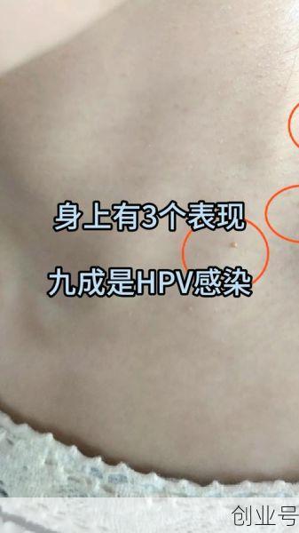 无症状感染自己有感觉吗,感染hpv有什么症状