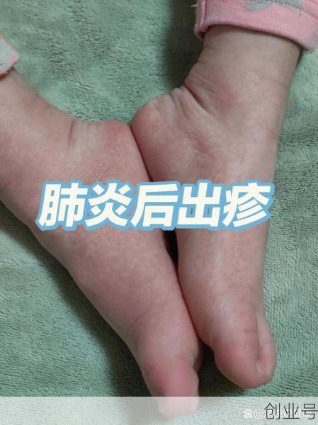 儿童病毒感染会有什么症状，儿童病毒感染的症状有哪些